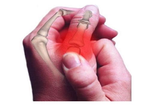Климакс - причина боли в суставах пальцев